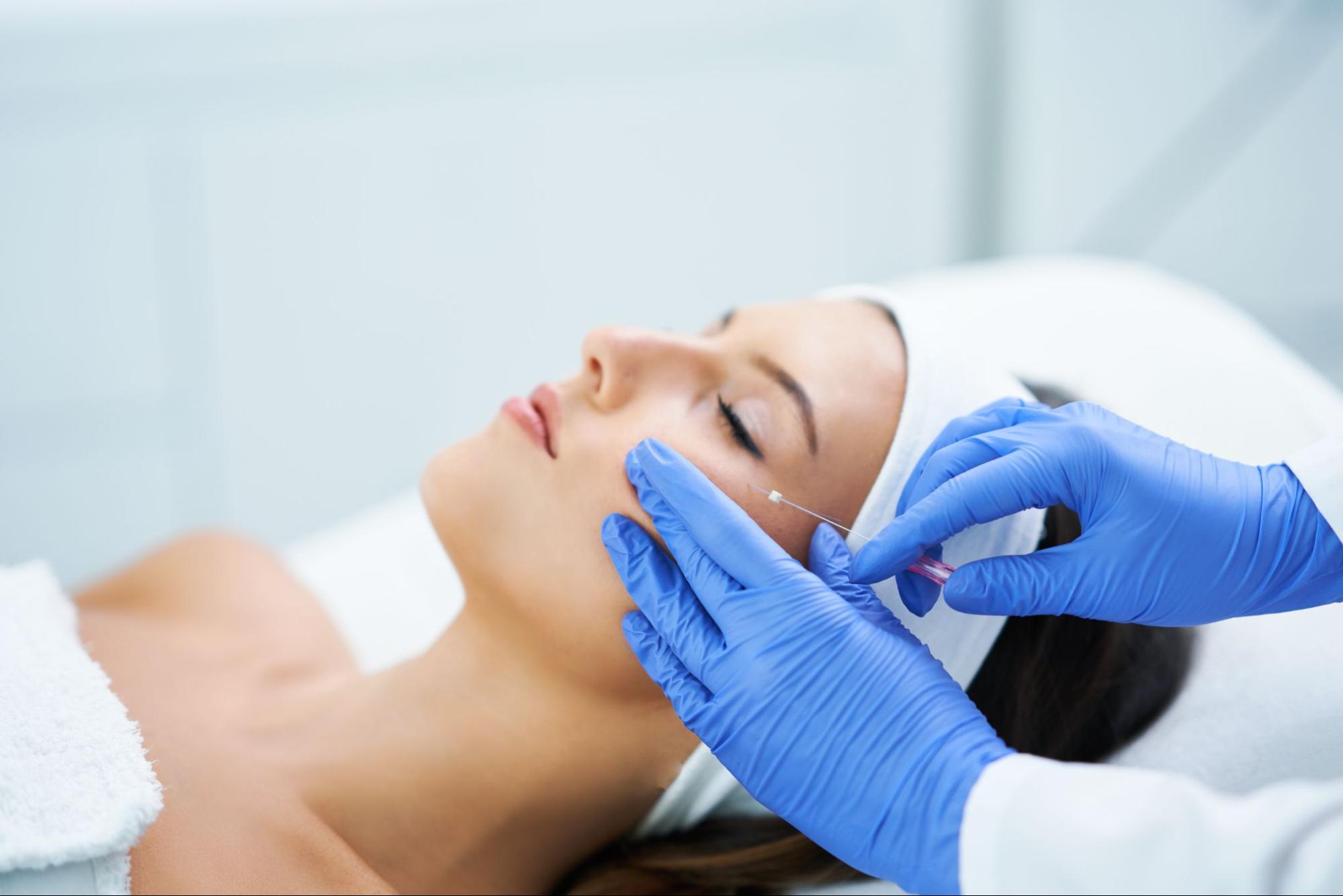 A patient undergoing a PDO thread lift procedure with a specialist inserting threads.