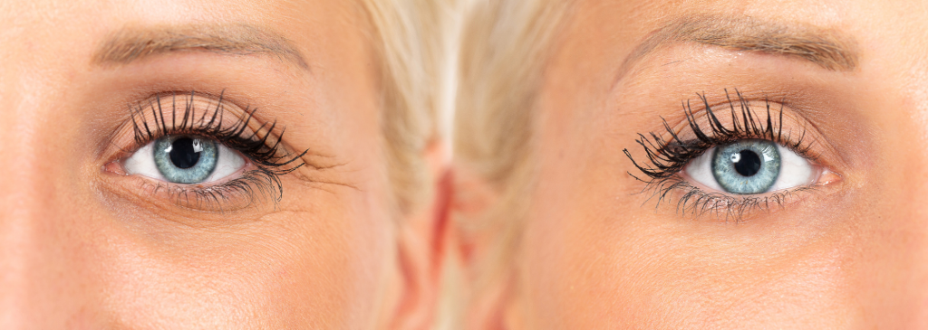 Close-up of a woman's eyes showing before and after Botox treatment, highlighting reduced wrinkles.