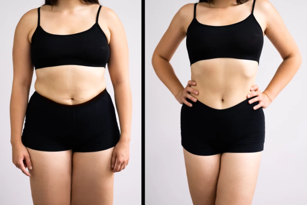 A before-and-after comparison of a woman’s weight loss progress with Tirzepatide treatment.