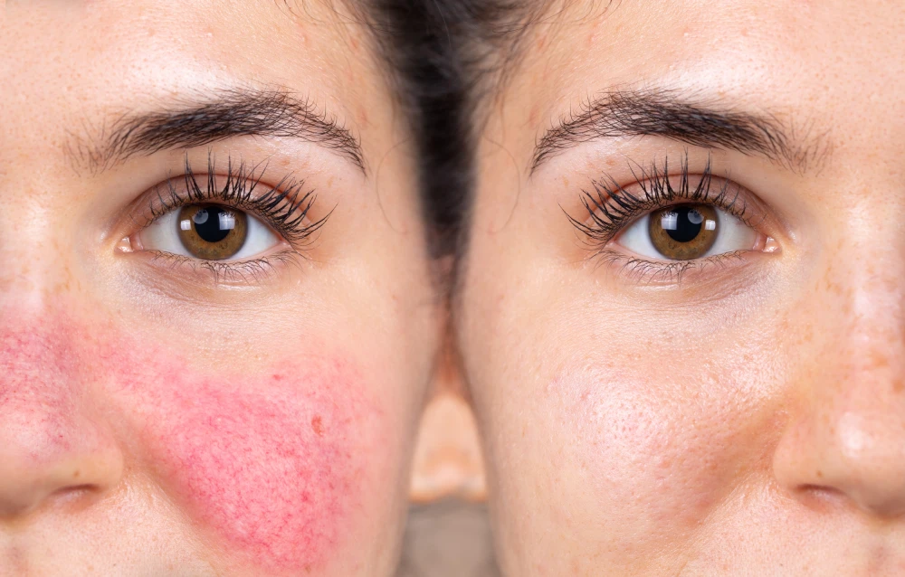 Woman with sensitive skin recovering from rosacea treatment.