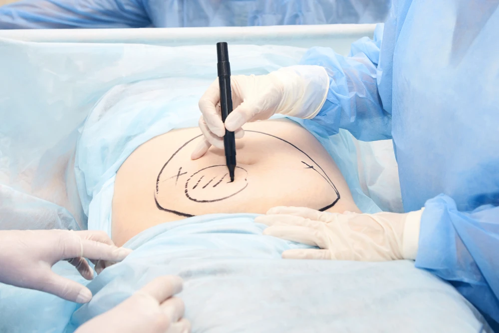 Surgeon marking the abdomen for a fat transfer procedure.