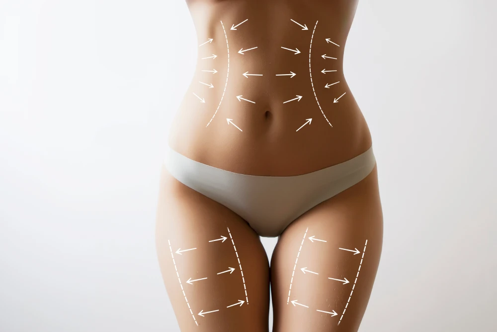 Woman’s contoured body with marked fat transfer areas.