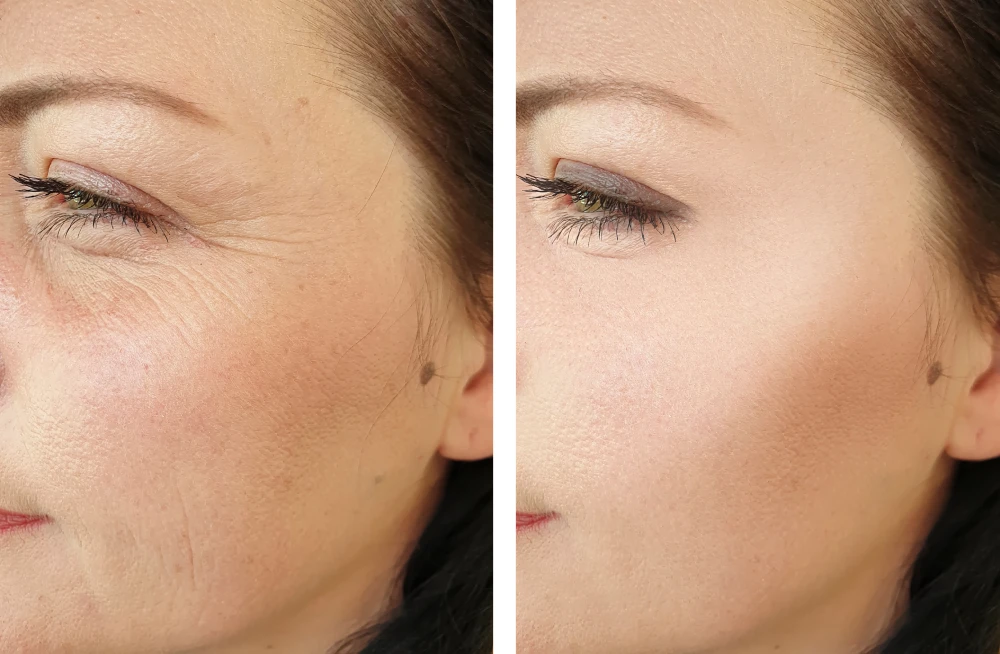 Before and after results showing reduced wrinkles from microneedling.