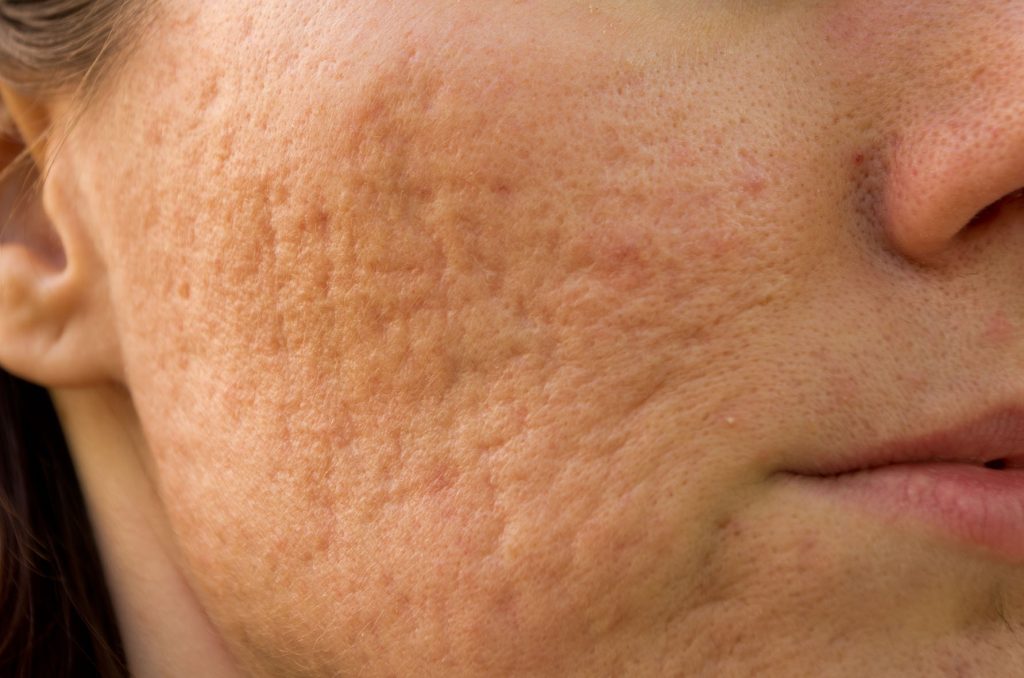 close-up of a person’s cheek and lower face showing visible pores and textured skin