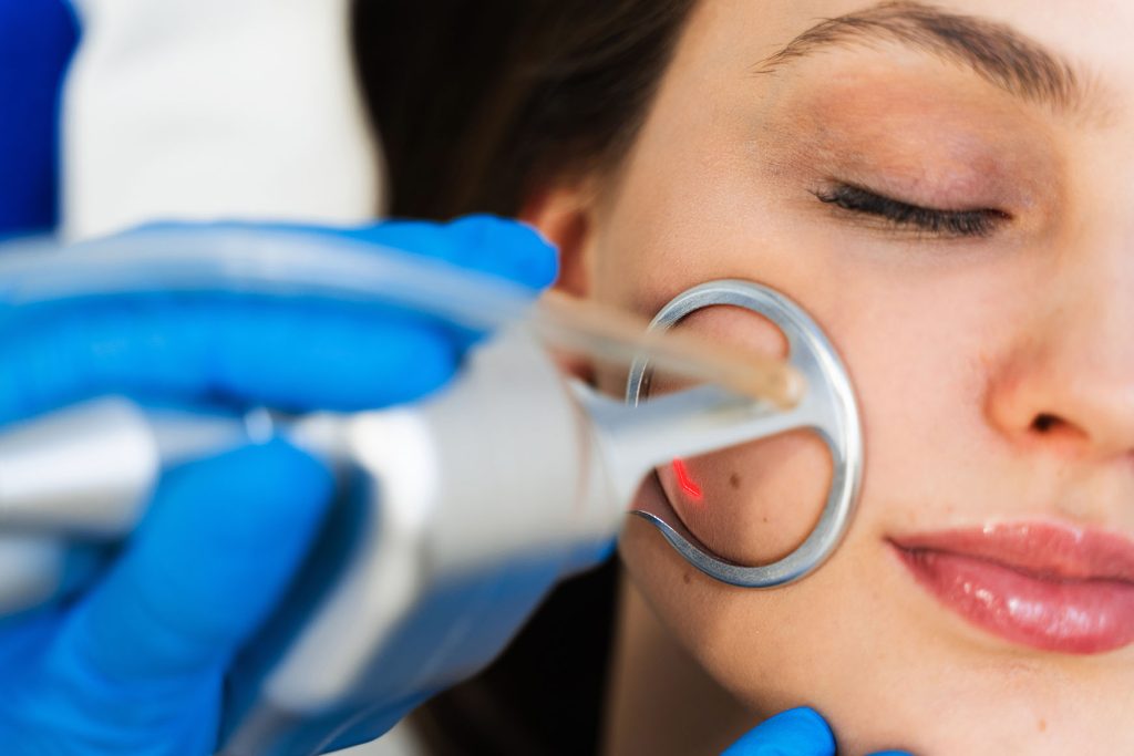 professional wearing blue gloves performing CO2 laser treatment on a woman’s cheek as she lies with eyes closed
