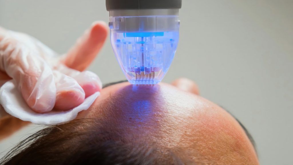 Close-up of a handheld microneedling device with blue light applied to a person’s forehead by a gloved hand.