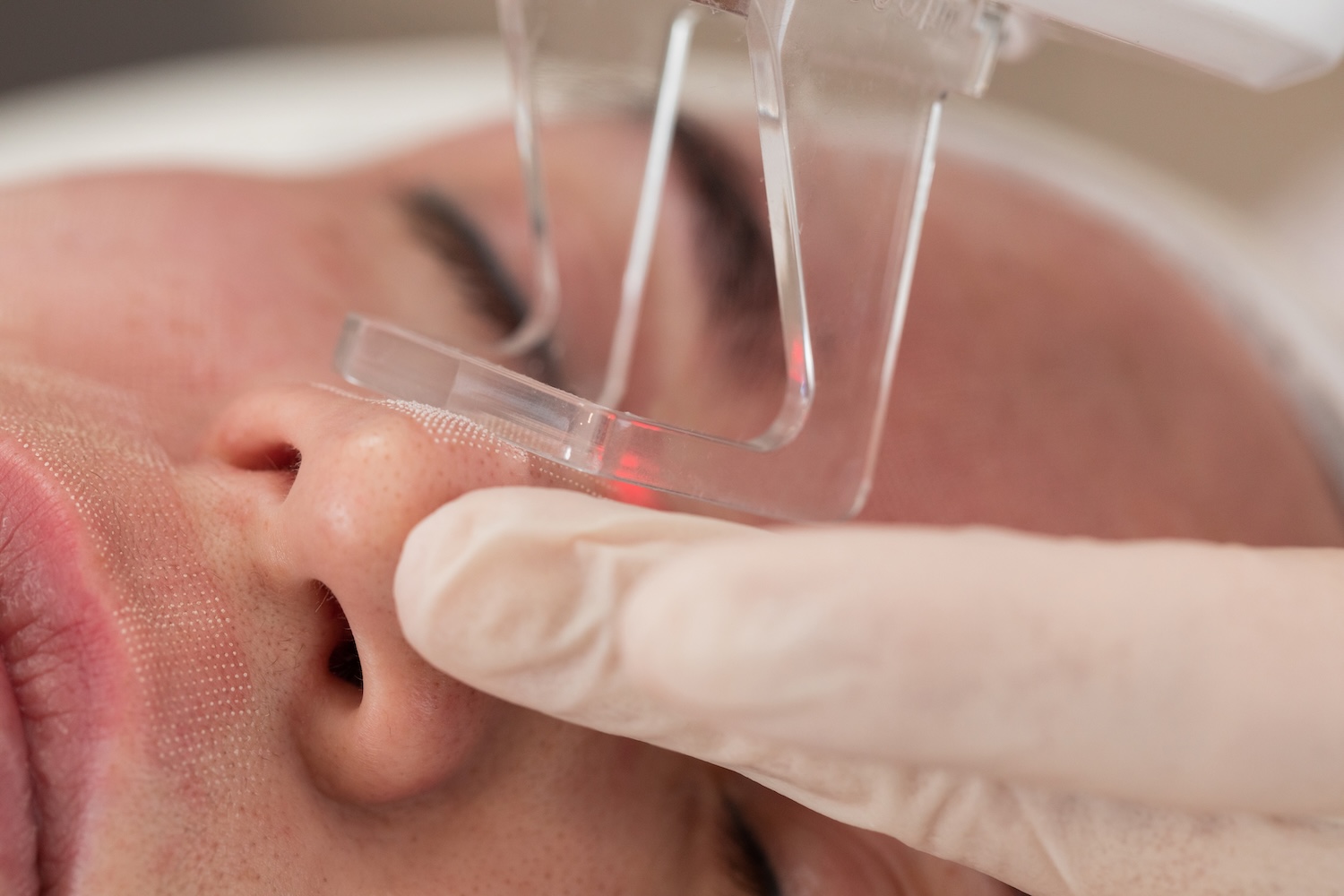 Gloved hand holds a laser device near a person’s nose while the person lies down with eyes closed