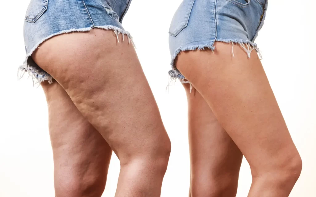 Side-by-side view of upper thighs in denim shorts showing visible dimpling on the left and smoother skin on the right.