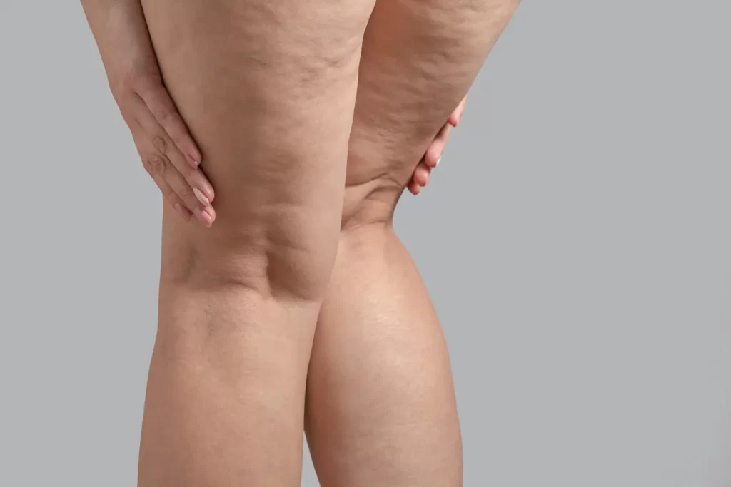 Person standing with hands on upper thighs showing visible dimpling and uneven skin texture.