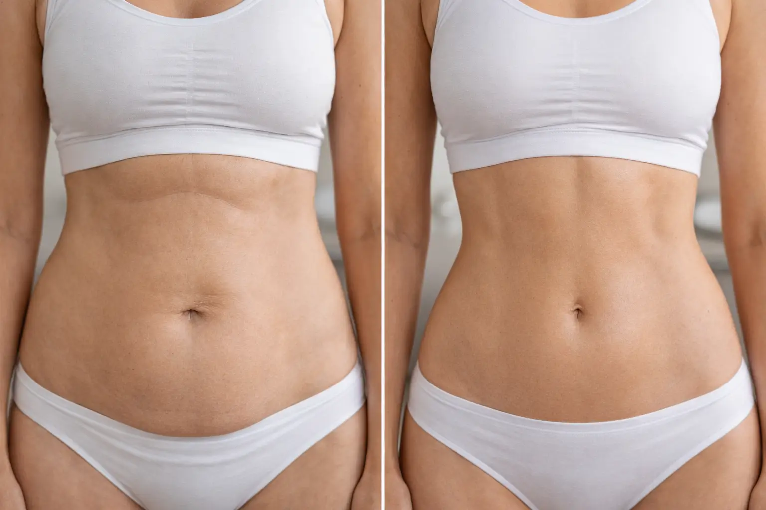 Before and after comparison of abdomen showing reduced fat and more defined contour after laser lipo treatment.